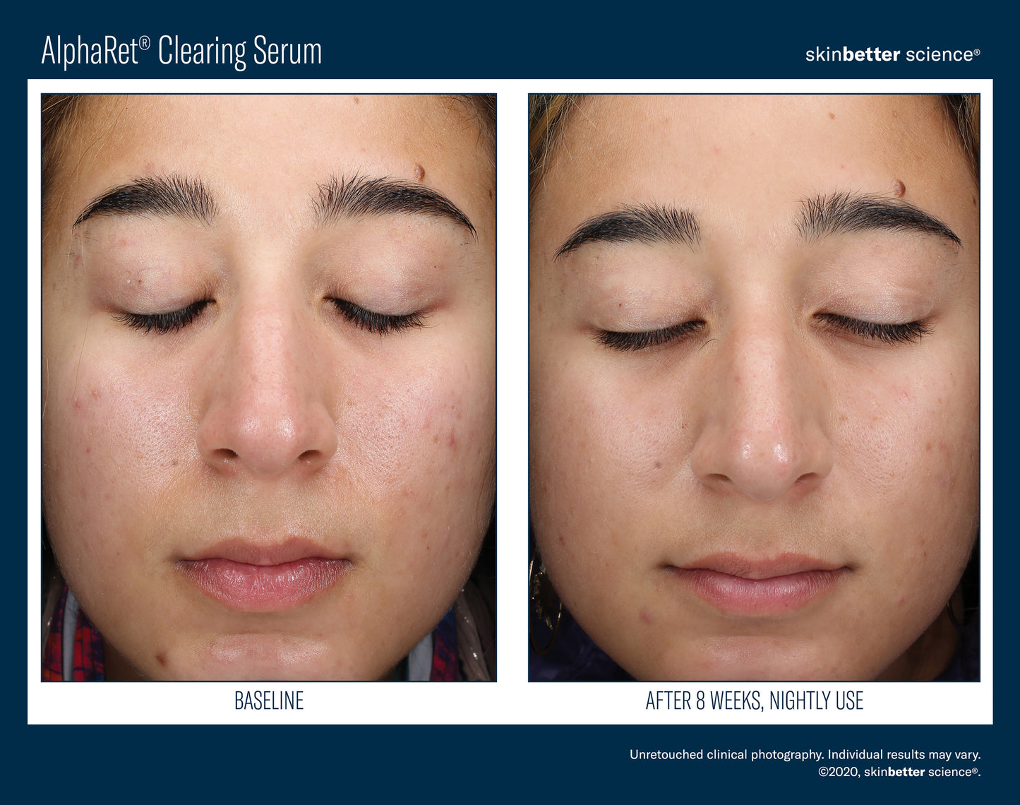 AlphaRet® Clearing Serum
