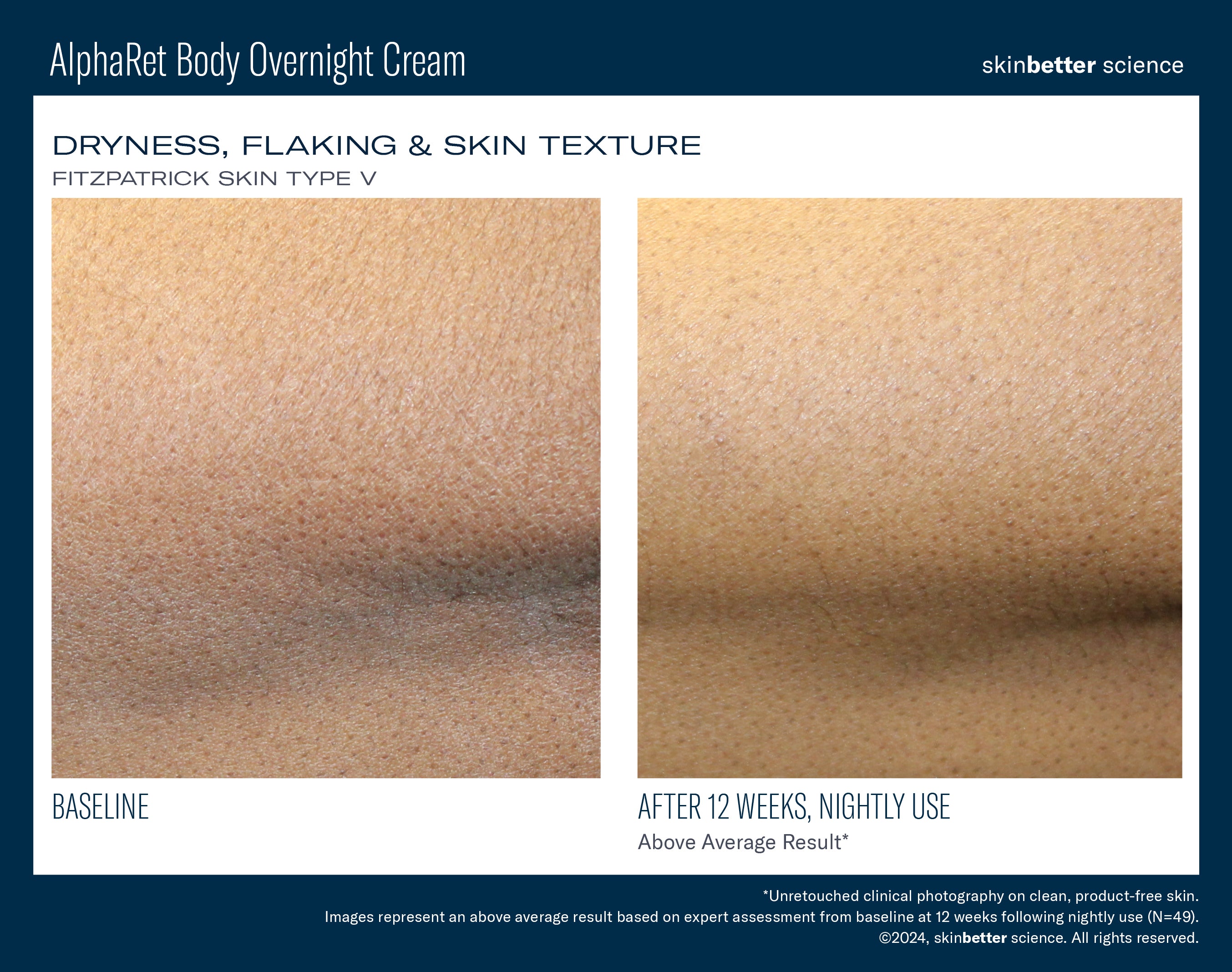AlphaRet® Body Overnight Cream