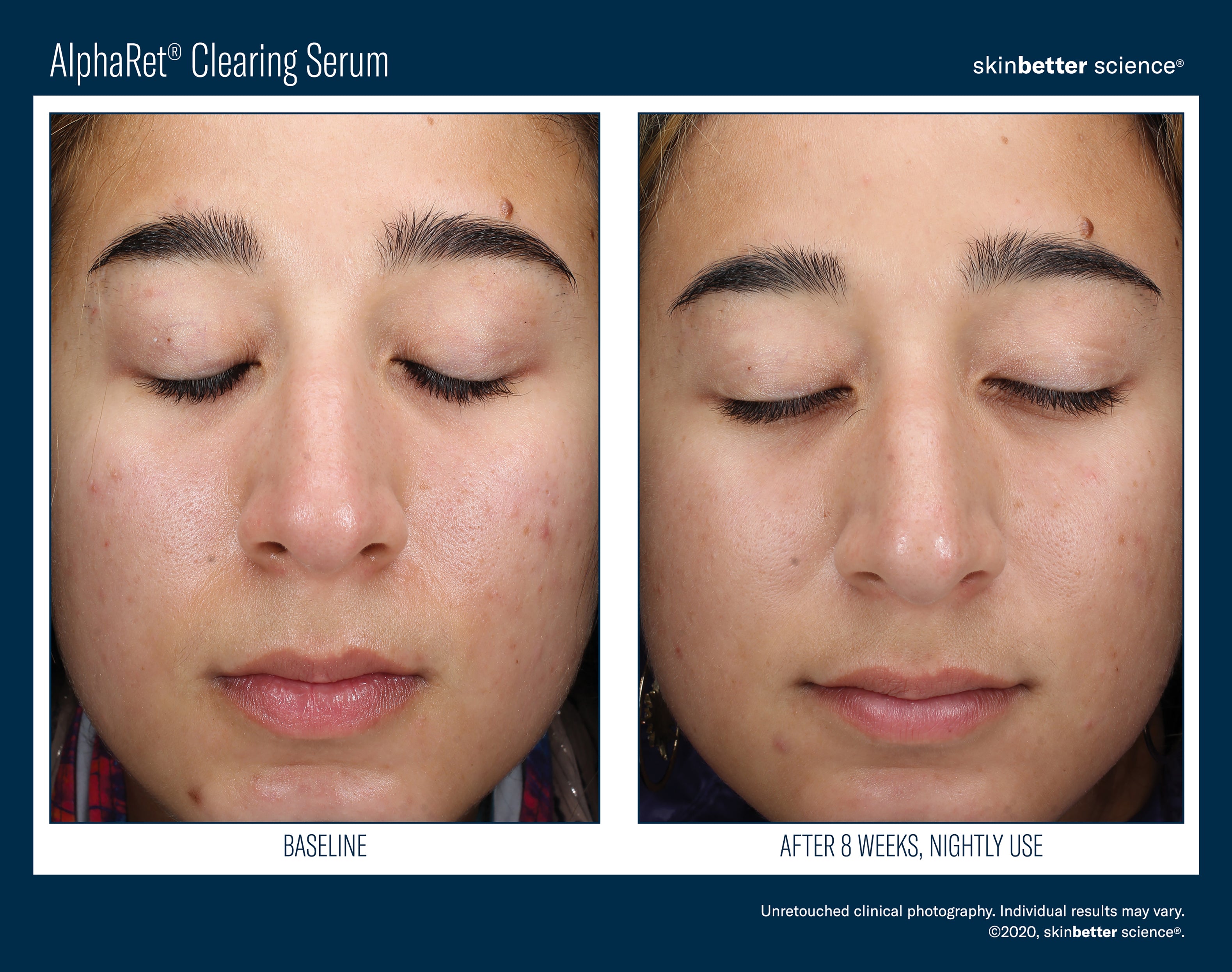 AlphaRet® Clearing Serum
