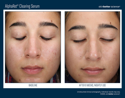 AlphaRet® Clearing Serum