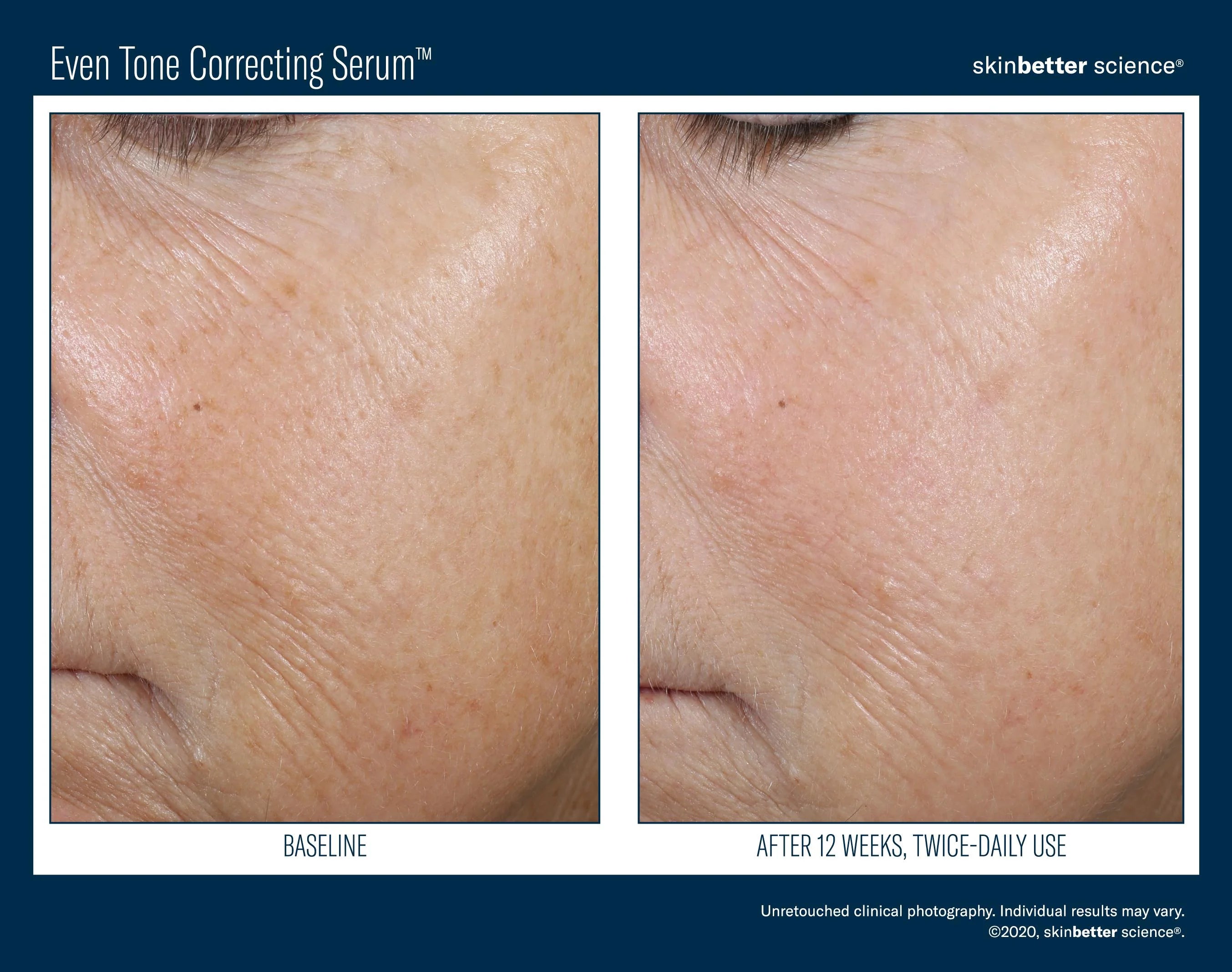 Even Tone Correcting Serum™