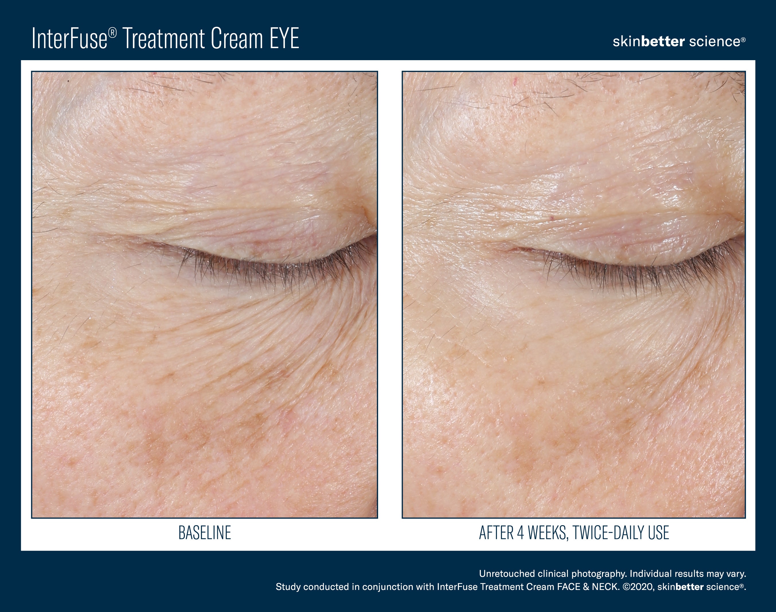 Interfuse® Treatment Cream EYE