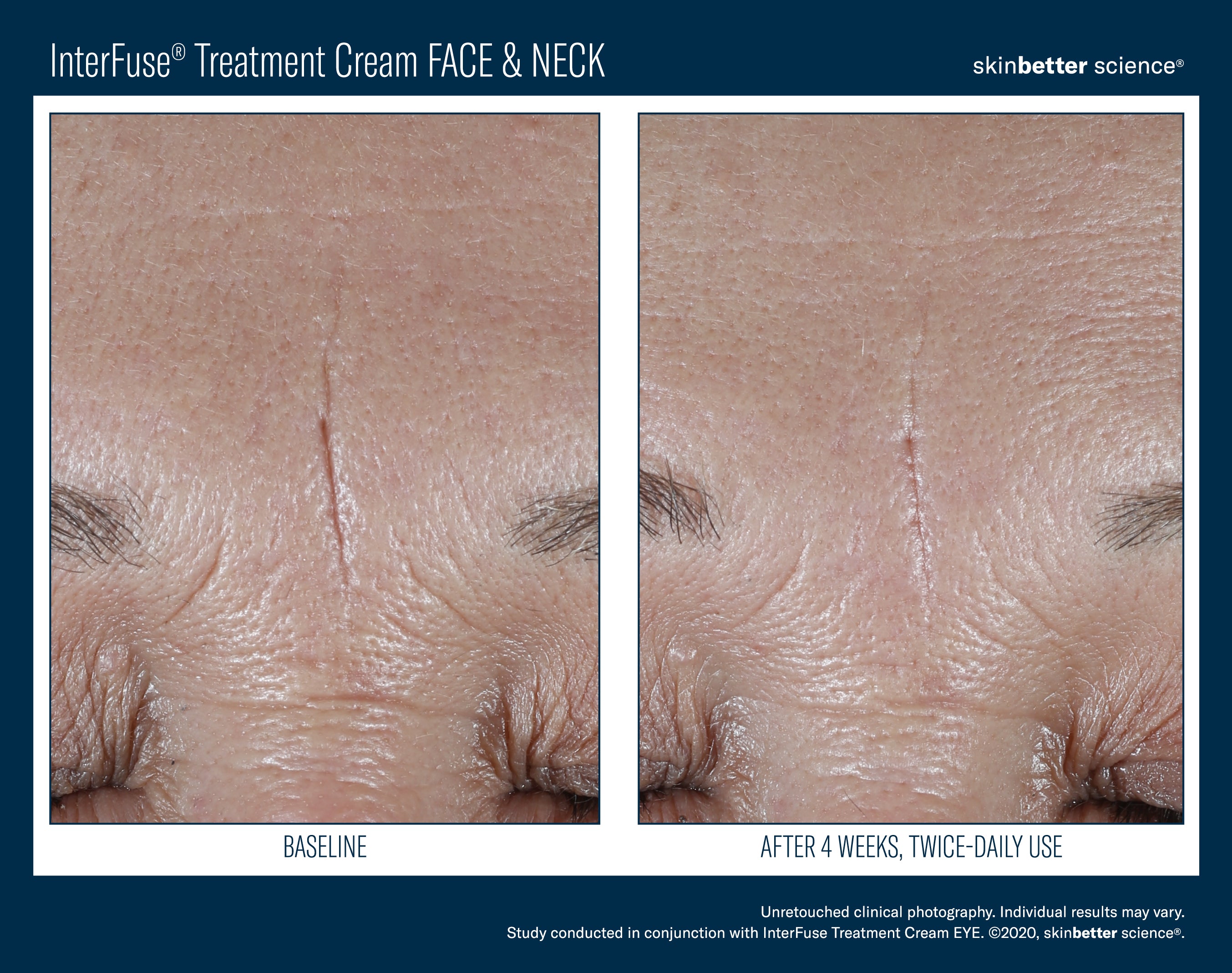Interfuse® Treatment Cream FACE & NECK