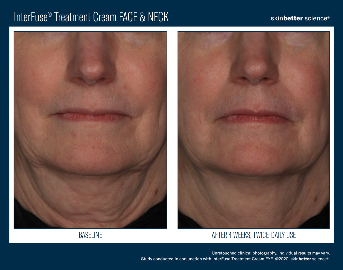 Interfuse® Treatment Cream FACE & NECK