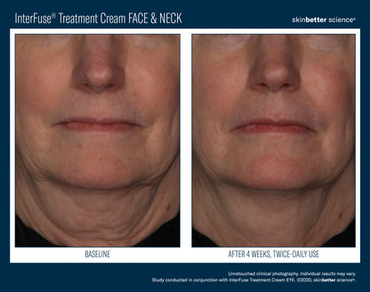 Interfuse® Treatment Cream FACE & NECK