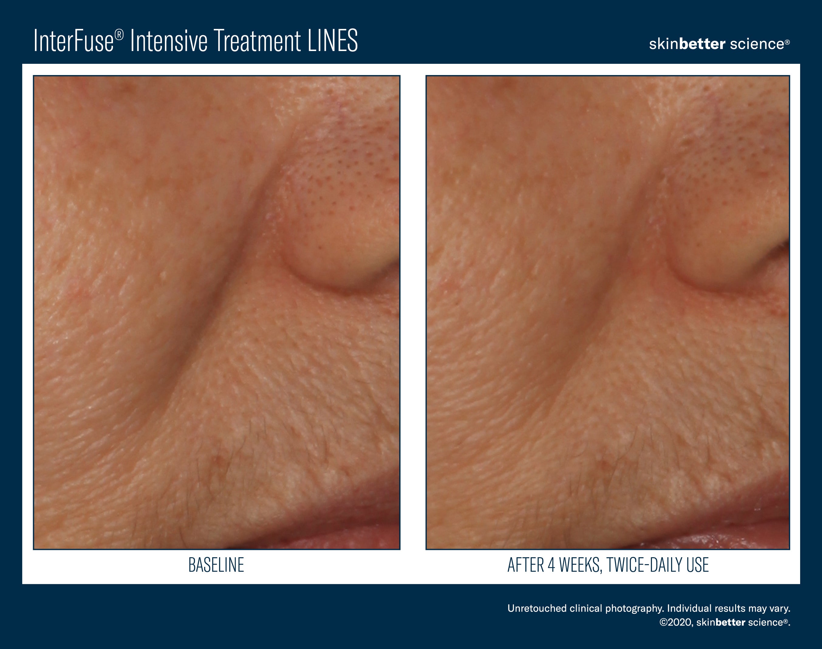 Interfuse® Intensive Treatment LINES