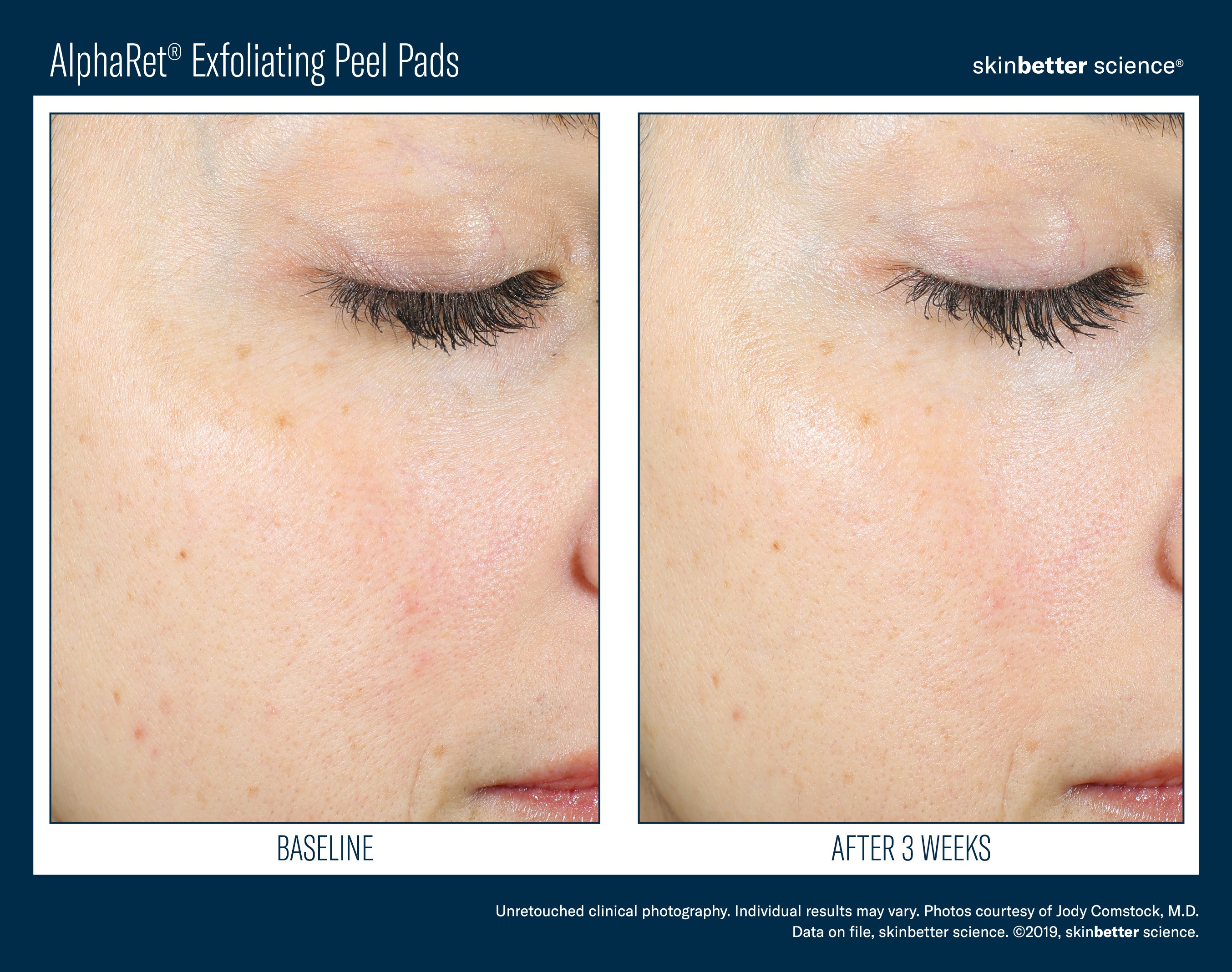 AlphaRet® Exfoliating Peel Pads