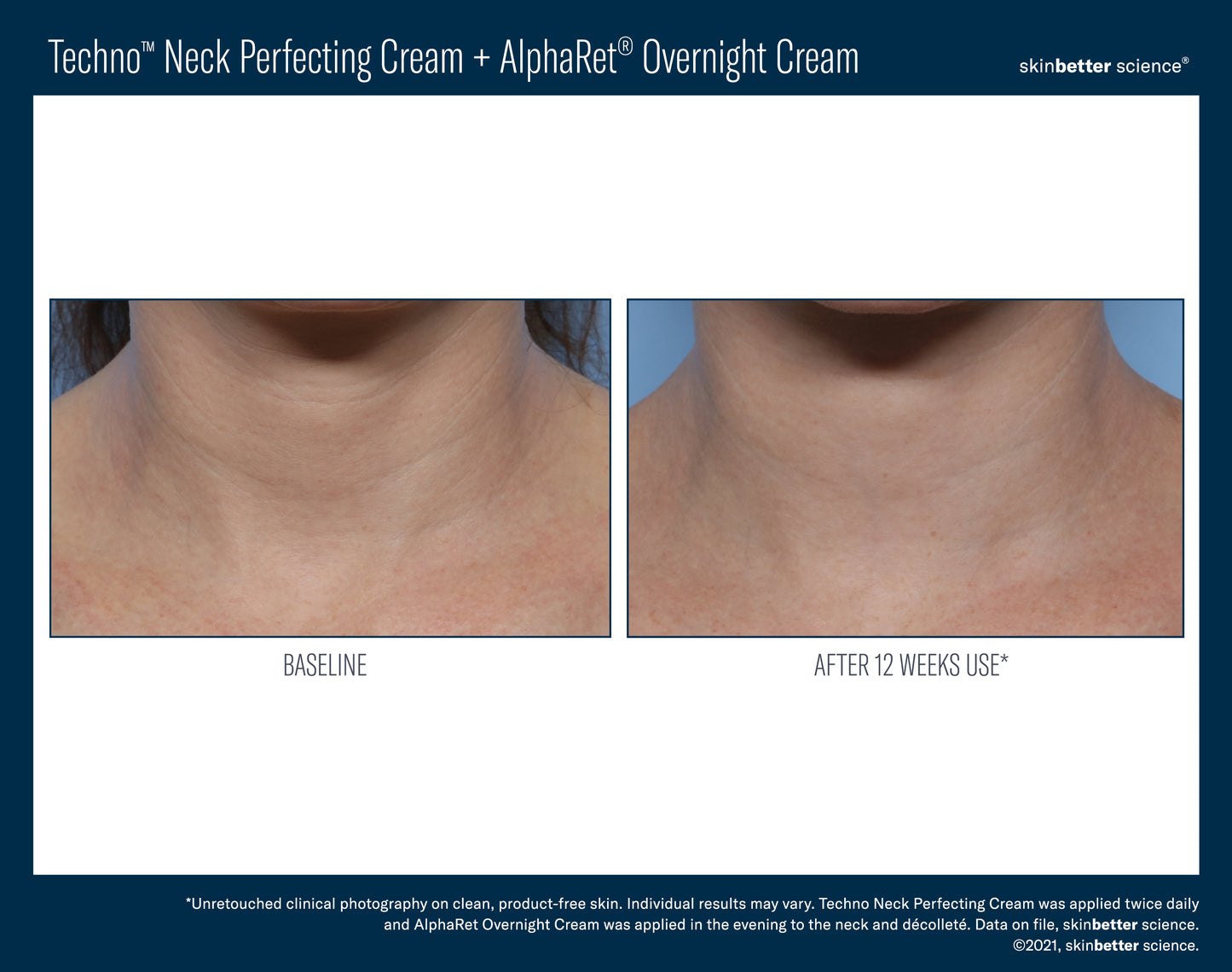 Techno™ Neck Perfecting Cream